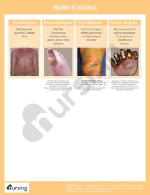 Burn Staging Cheatsheet.pdf