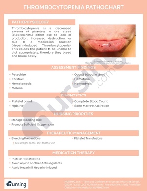 Thrombocytopenia Pathochart.pdf