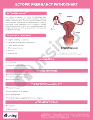 Ectopic Pregnancy Pathochart.pdf