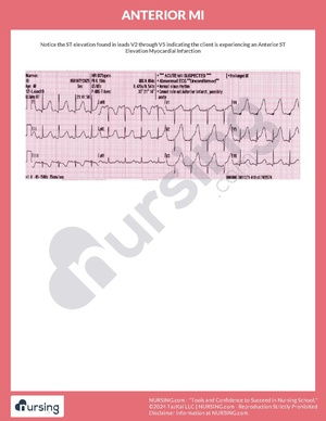 Anterior MI.pdf
