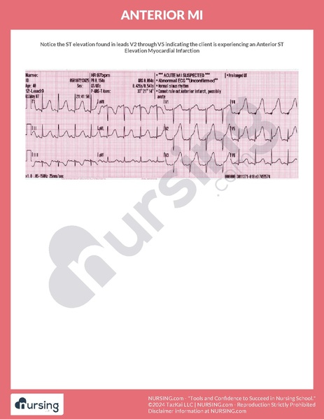 File:Anterior MI.pdf