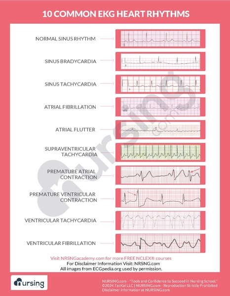 File:10 Common EKG Heart Rhythms.pdf