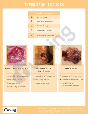 Types of Skin Cancer.pdf