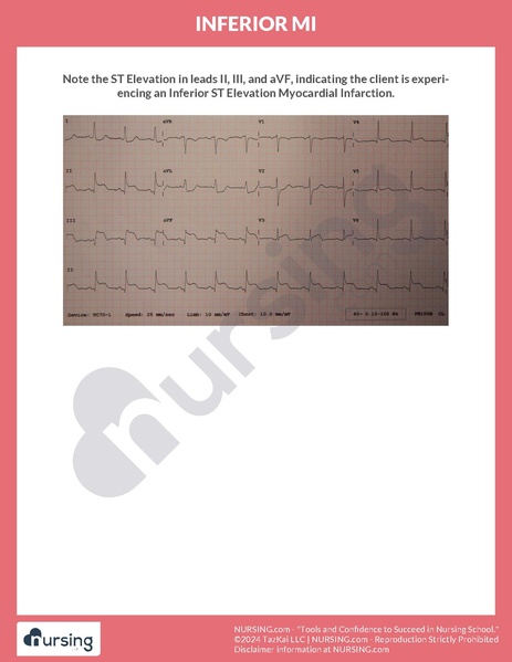 File:Inferior MI.pdf