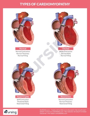 Types of Cardiomyopathy Chart.pdf